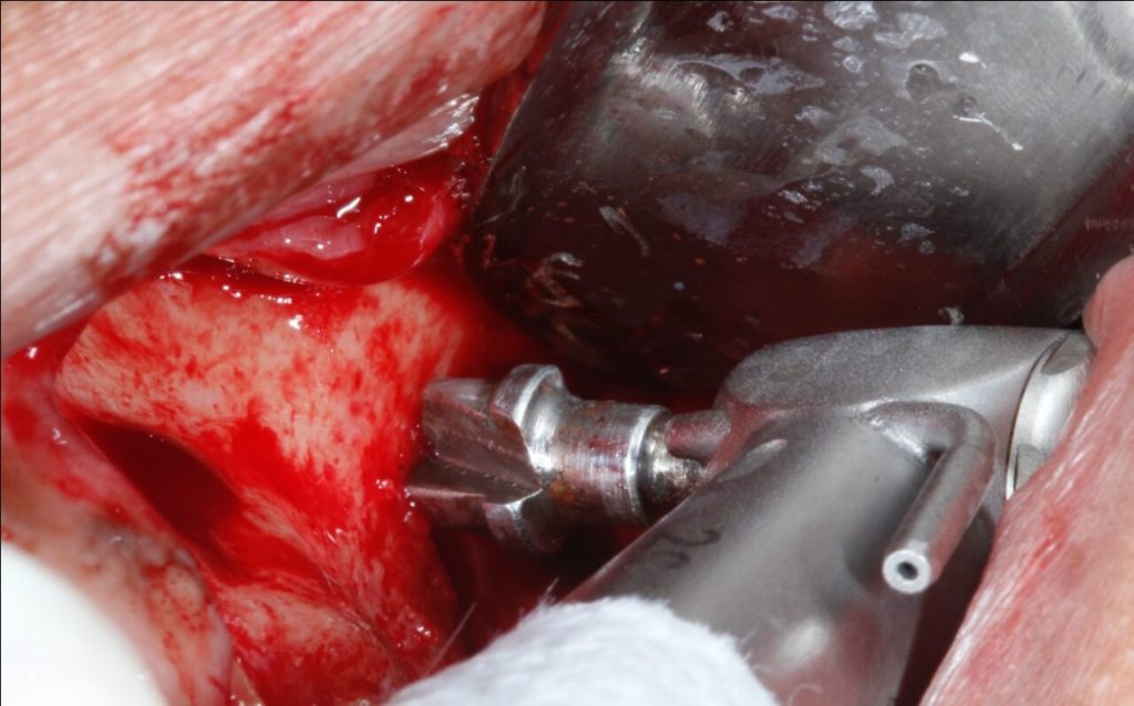 2 11 - Levantamento de seio maxilar com instalação concomitante de Implantes: relato de caso clínico
