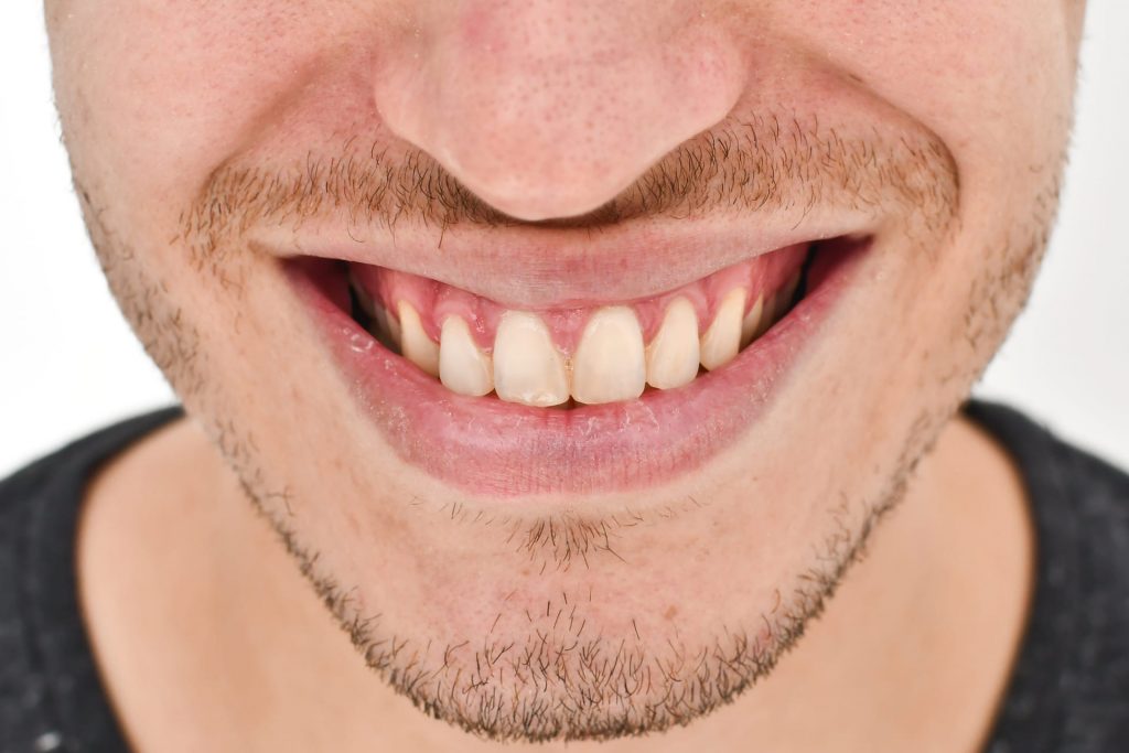 2A1 - Restabelecimento do corredor bucal e do sorriso com cirurgia plástica periodontal e laminados cerâmicos