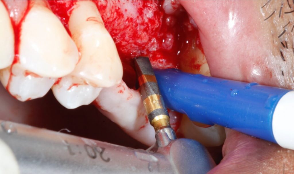 4 11 - Levantamento de seio maxilar com instalação concomitante de Implantes: relato de caso clínico