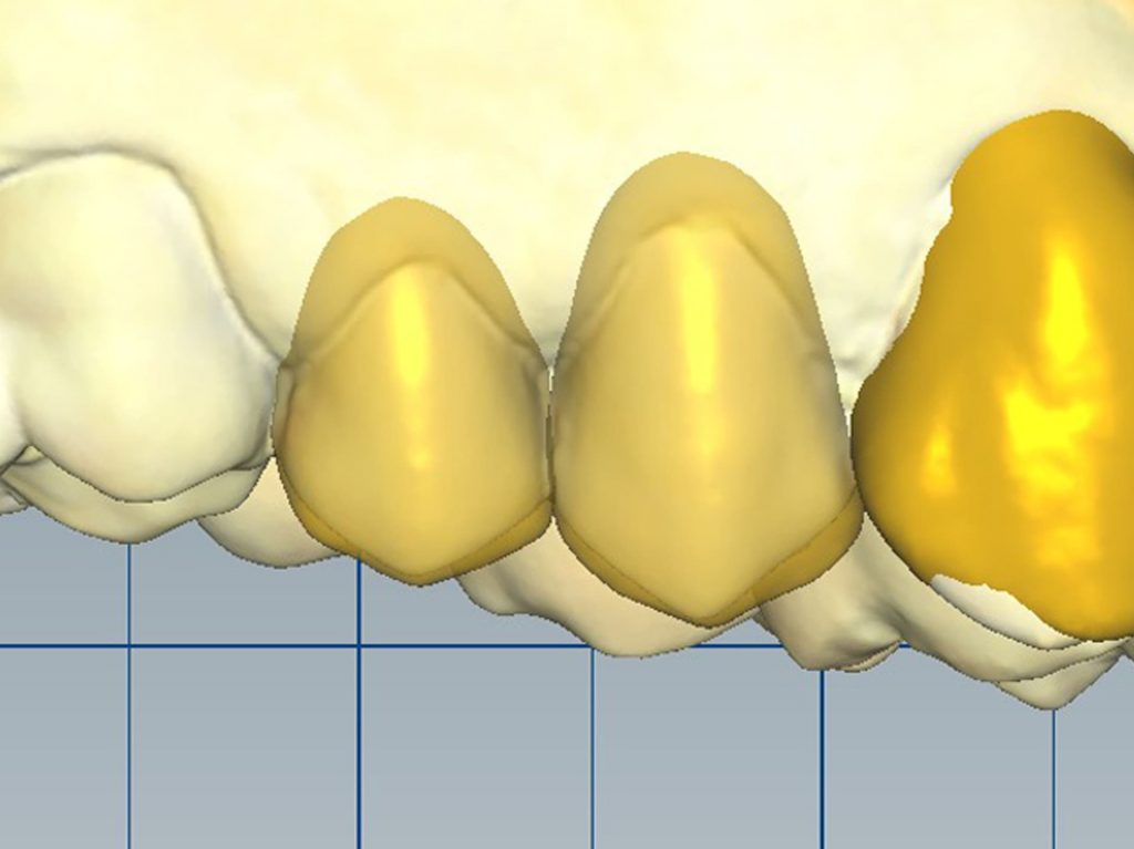 4A1 - Restabelecimento do corredor bucal e do sorriso com cirurgia plástica periodontal e laminados cerâmicos