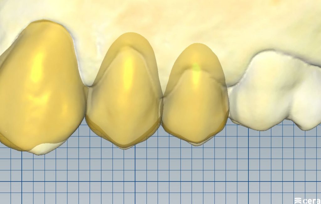 4B1 - Restabelecimento do corredor bucal e do sorriso com cirurgia plástica periodontal e laminados cerâmicos