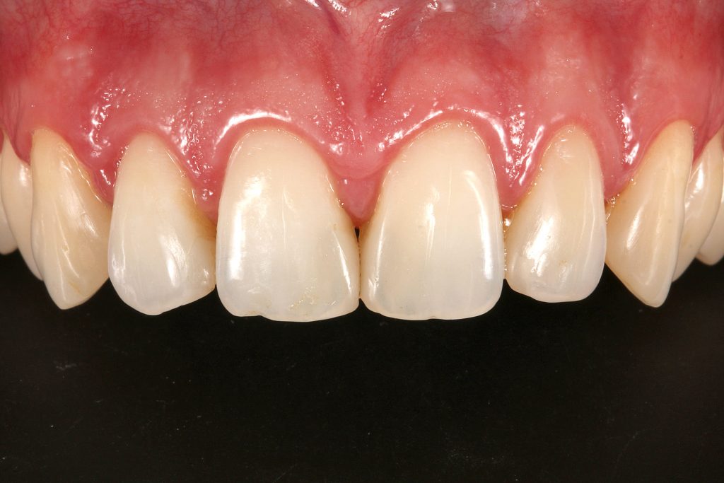 5A1 - Restabelecimento do corredor bucal e do sorriso com cirurgia plástica periodontal e laminados cerâmicos