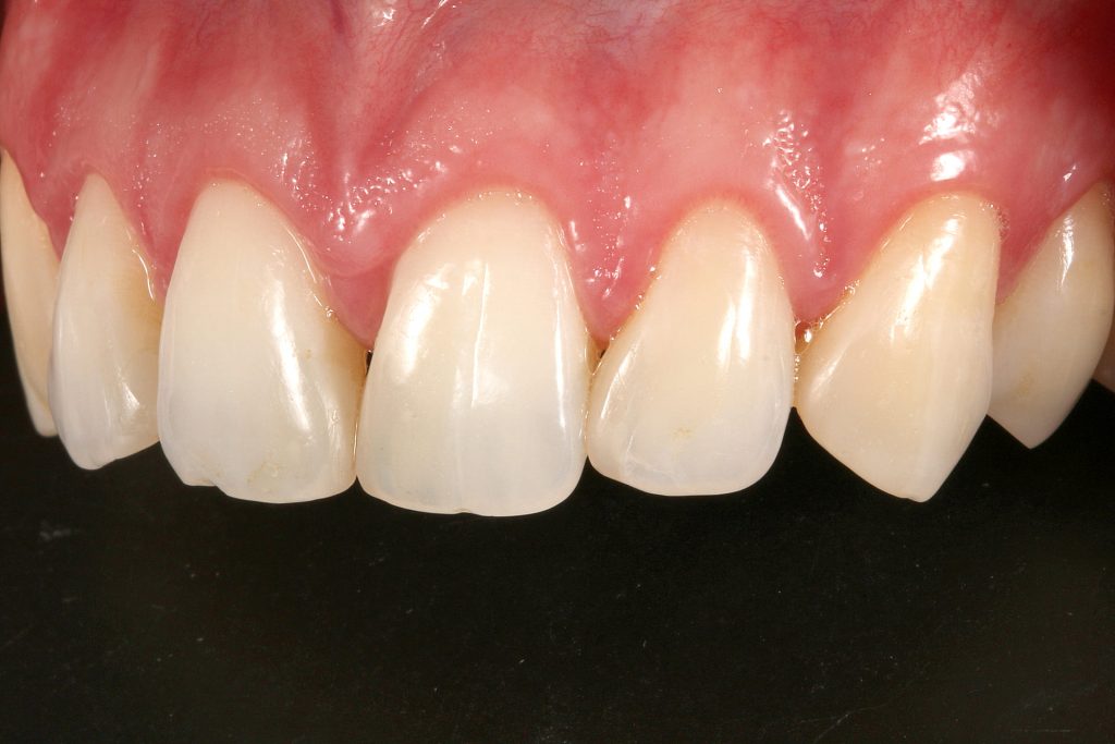 5B1 - Restabelecimento do corredor bucal e do sorriso com cirurgia plástica periodontal e laminados cerâmicos