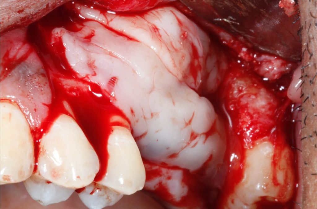 81 1 - Levantamento de seio maxilar com instalação concomitante de Implantes: relato de caso clínico