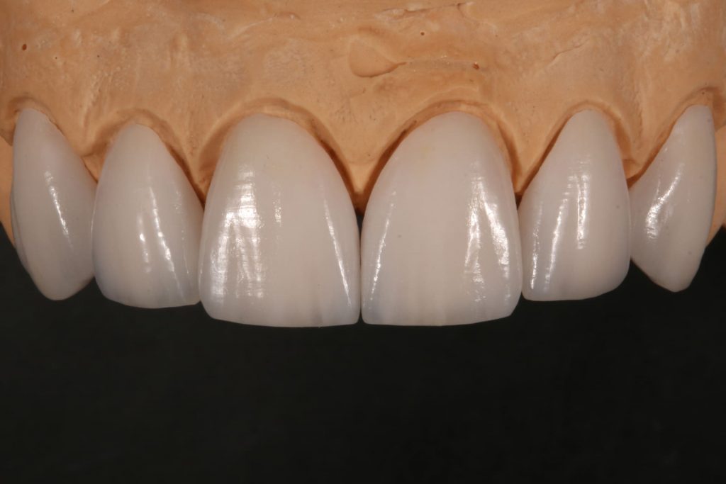 8A1 - Restabelecimento do corredor bucal e do sorriso com cirurgia plástica periodontal e laminados cerâmicos