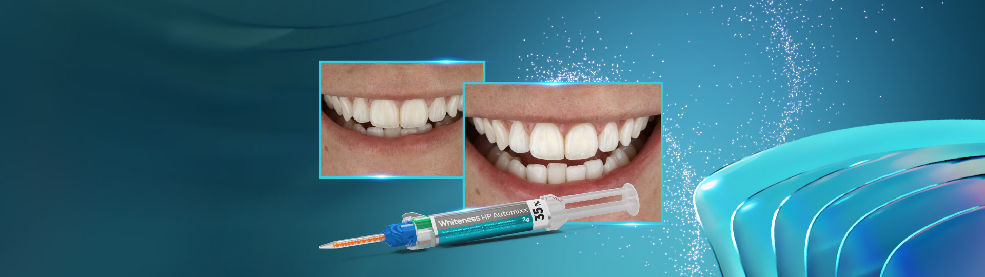 Tooth whitening in the office: a fast and effective alternative for immediate whitening
