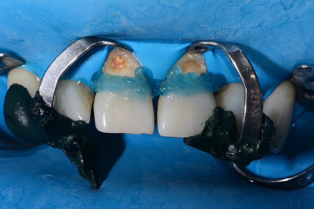 FIGURA 6 acido fosforico aplicado sobre o dente1 - Lesão cervical de Classe V restaurada com resina unicromática Vittra APS Unique Flow