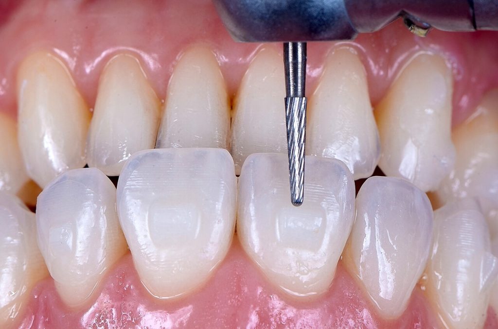 Fig. 10 Aspecto dos attachments imediatamente apos a remocao do template1 - Application of Vittra APS Unique as an esthetic alternative for making attachments for orthodontic aligners