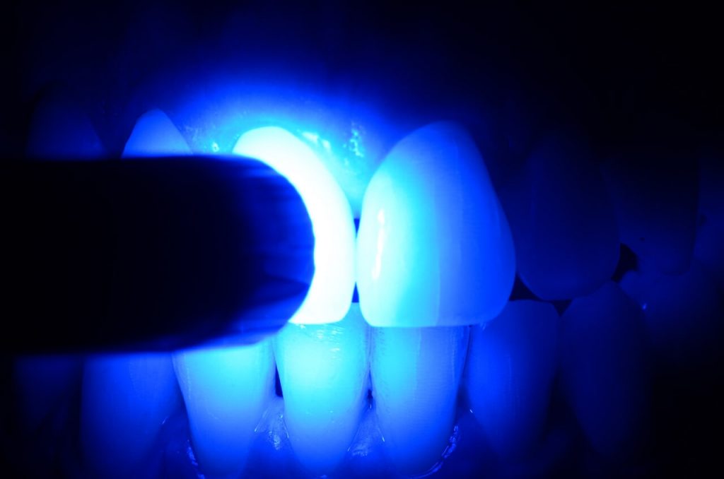 Fig. 6 Fotoativacao do adesivo1 - Application of Vittra APS Unique as an esthetic alternative for making attachments for orthodontic aligners