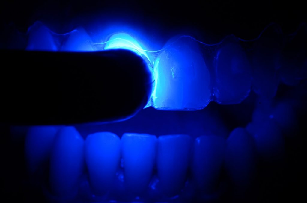 Fig. 9 Fotoativacao das resinas nos slots1 - Application of Vittra APS Unique as an esthetic alternative for making attachments for orthodontic aligners