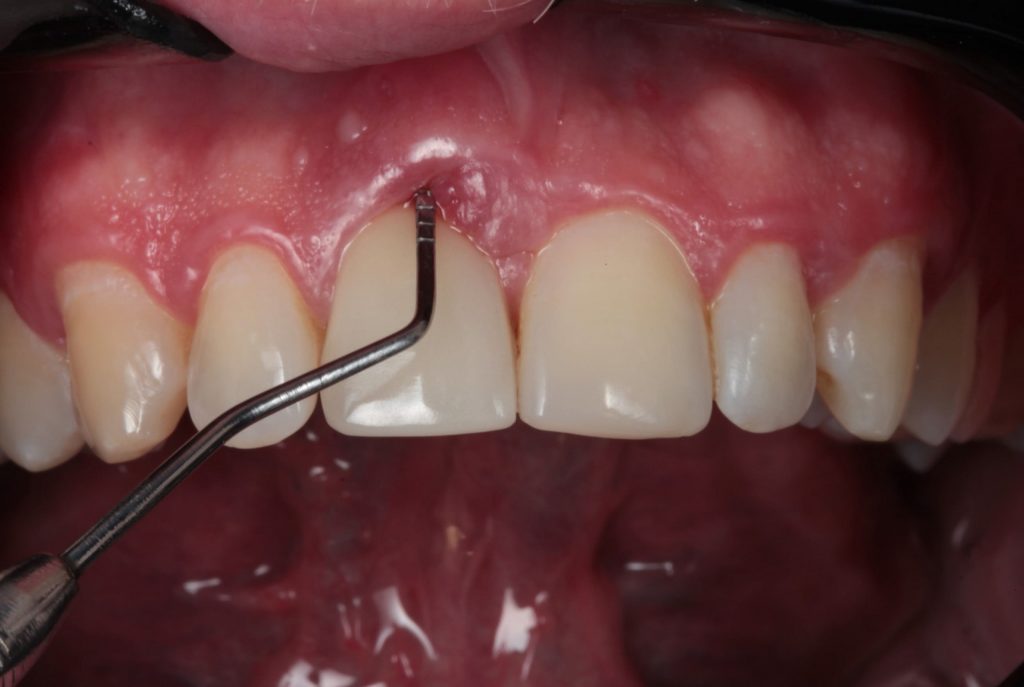 Fig01 scaled1 - Implante imediato com provisionalização imediata e Enxerto de tecido conjuntivo: Um relato de caso