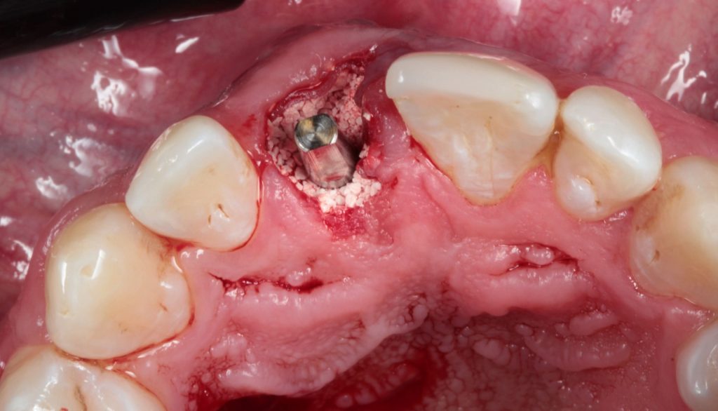 Fig03 scaled1 - Immediate implant with immediate provisioning and connective tissue graft: a case report