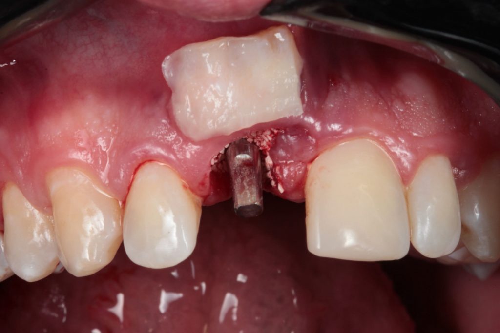 Fig04 scaled1 - Implante imediato com provisionalização imediata e Enxerto de tecido conjuntivo: Um relato de caso