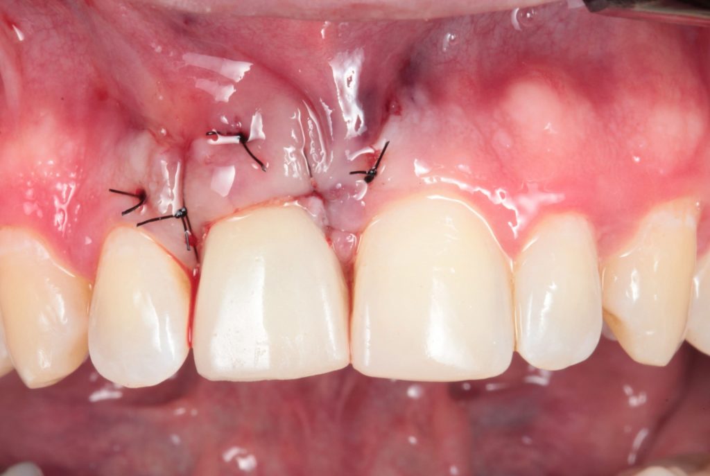 Fig05 scaled1 - Implante imediato com provisionalização imediata e Enxerto de tecido conjuntivo: Um relato de caso