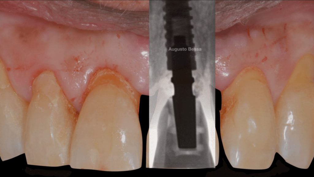 Figura 13 Implante instalado e coroa provisoria capturada1 - Tratamento de fratura em incisivo central superior com reabilitação através de implante imediato realizado com guia cirúrgica virtual: relato de caso clínico