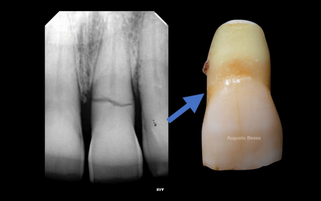 Figura 2 Fratura do elemento dentario do 21 confirmada atraves do RX periapical1 - Tratamento de fratura em incisivo central superior com reabilitação através de implante imediato realizado com guia cirúrgica virtual: relato de caso clínico