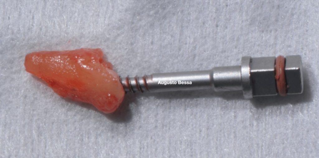 Figura 4 Extracao atraumatica do elemento dentario do 211 - Tratamento de fratura em incisivo central superior com reabilitação através de implante imediato realizado com guia cirúrgica virtual: relato de caso clínico