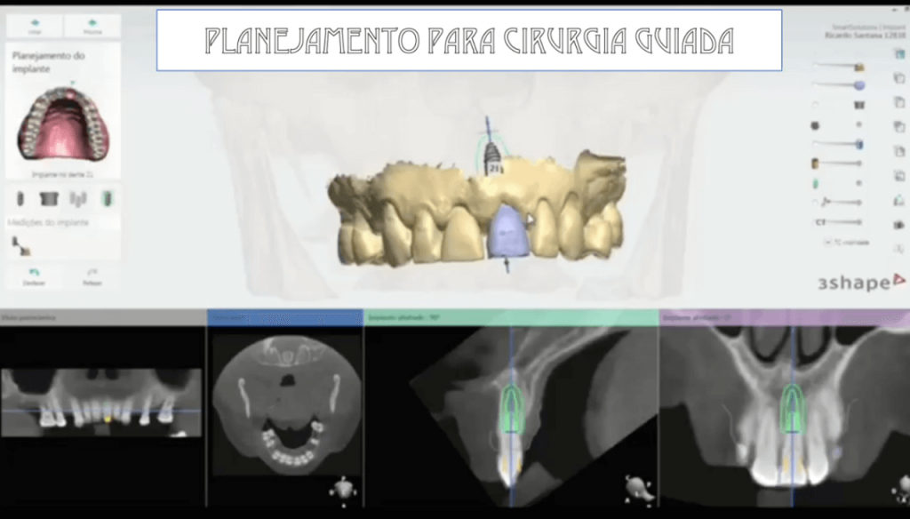 Figura 5 Planejamento para guia cirurgico 3Shape1 - Tratamento de fratura em incisivo central superior com reabilitação através de implante imediato realizado com guia cirúrgica virtual: relato de caso clínico