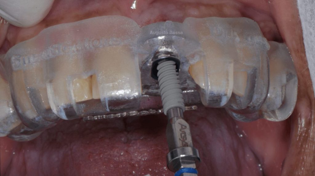 Figura 9 Instalacao do implante1 - Tratamento de fratura em incisivo central superior com reabilitação através de implante imediato realizado com guia cirúrgica virtual: relato de caso clínico