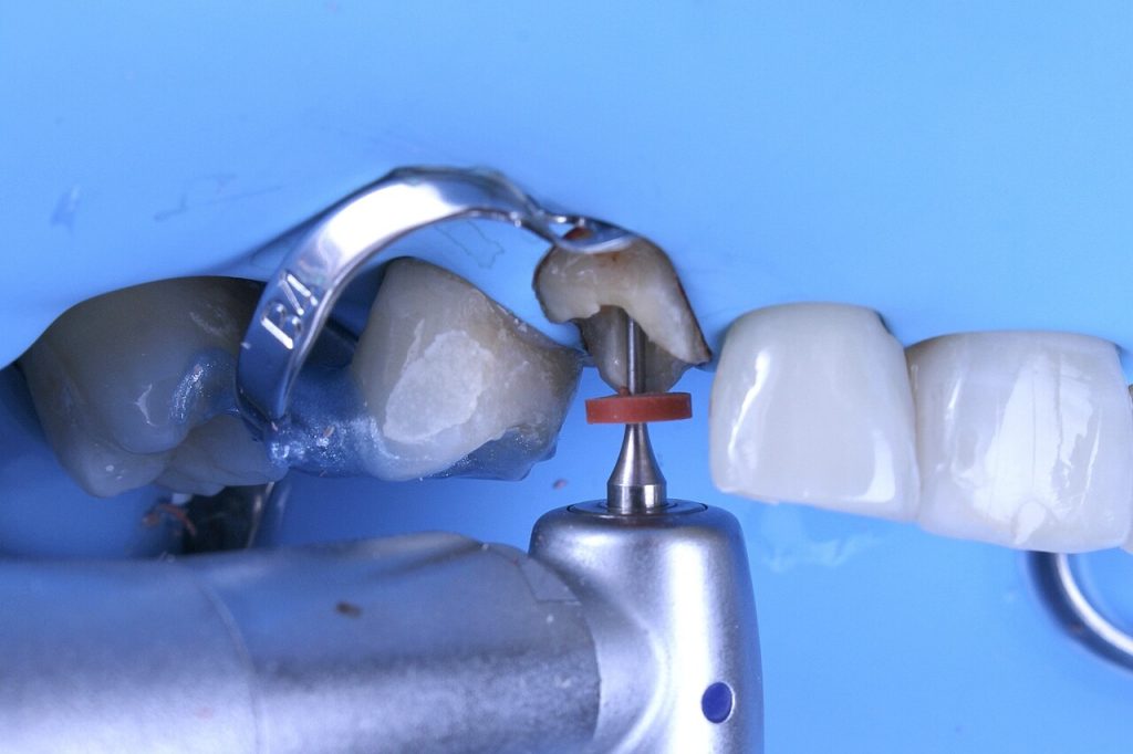 Fig. 6 Remoção da guta-percha com broca de largo mantendo 5 mm na região apical