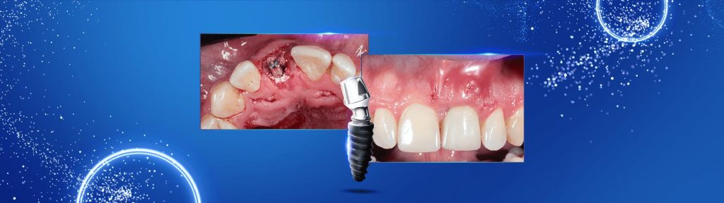 Implante imediato com provisionalizacao 11 - Immediate implant with immediate provisioning and connective tissue graft: a case report