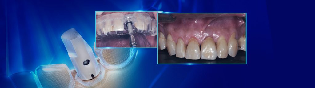 Tratamento de fratura em incisivo central superior com 11 - Treatment of a fracture on an upper central incisor with rehabilitation through immediate implant carried out with a virtual surgical guide: a clinical case report