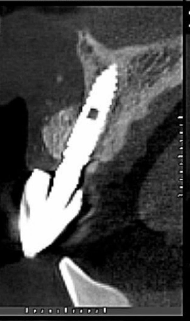 download21 - Implante imediato com provisionalização imediata e Enxerto de tecido conjuntivo: Um relato de caso
