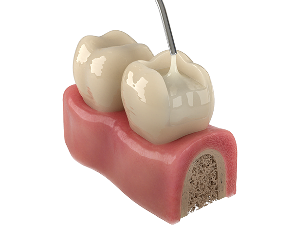 fluida1 - Resinas Bulk Fill: Efetividade e economia de tempo à serviço da odontologia