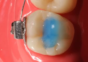 thumbnail image 2 of Dental TURBO Blue Light Cure Composite Resin – Orthodontic Adhesive For Bands 2 of 4