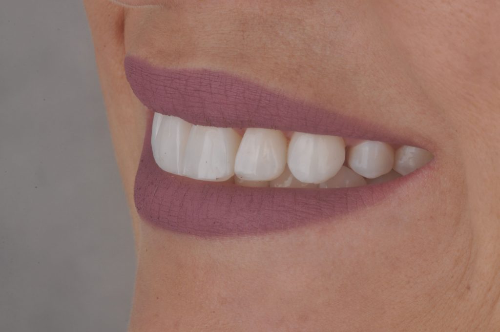 n3 final sorriso lateral scaled1 - Resina Vittra APS: Carillas estéticas con los nuevos colores Bleach