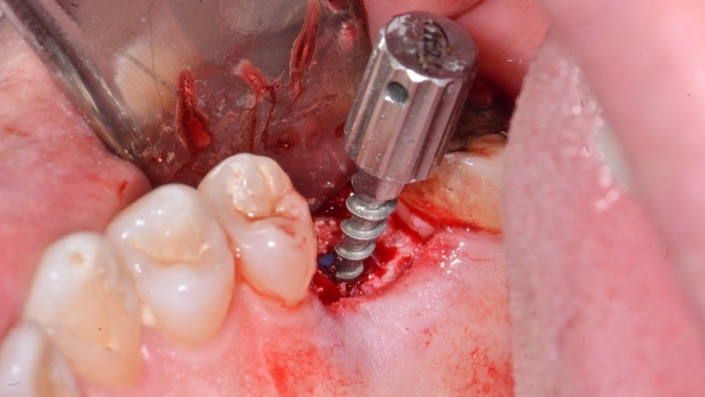 10 705x3971 1 - Arcsys short implant installed in inter-root septum and filling of alveolus with Nanosynt