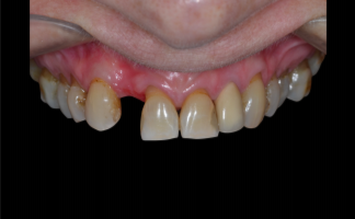 Imagem11 1 - Rehabilitación dento-alveolar con implante Arcsys, injerto conjuntivo y sustituto óseo Nanosynt