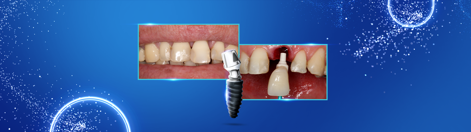 Implante imediato com carga imediata sobre cicatrizador personalizando area peri implantar1 - Implante inmediato con carga inmediata sobre cicatrizador personalizando área peri-implantar.