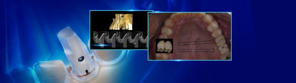 levantamento de seio maxilar1 - Levantamiento de seno maxilar con instalación concomitante de implantes: Relato de caso clínico.
