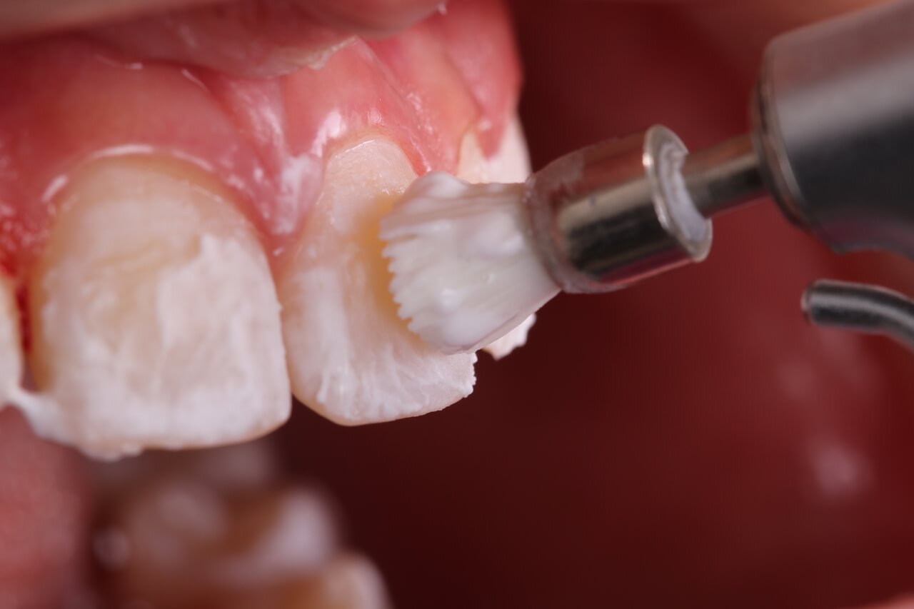 Fig. 2 Dental prophylaxis with pumice stone prior to orthodontic bonding.

