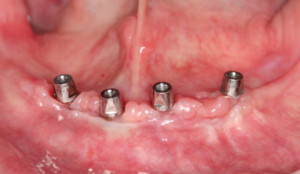 Fig 2 – Componentes protéticos instalados sobre implantes friccionais (Arcsys – FGM)
