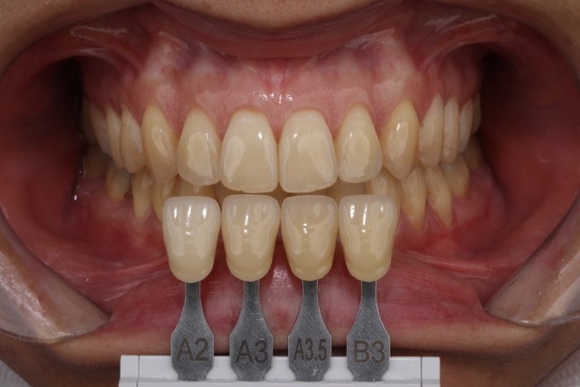 Fig. 1 – Initial coloring of upper anterior teeth: A3 in incisors and A3.5 canines