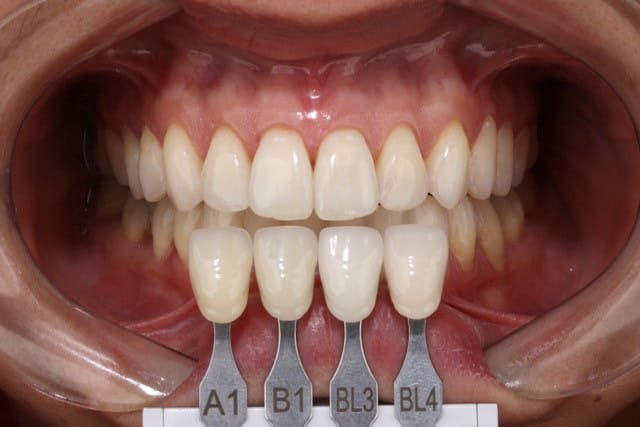 Fig. 4 – Final aspect of the smile.