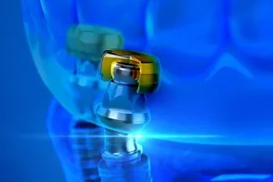 MOBILE_Banner_overdenture