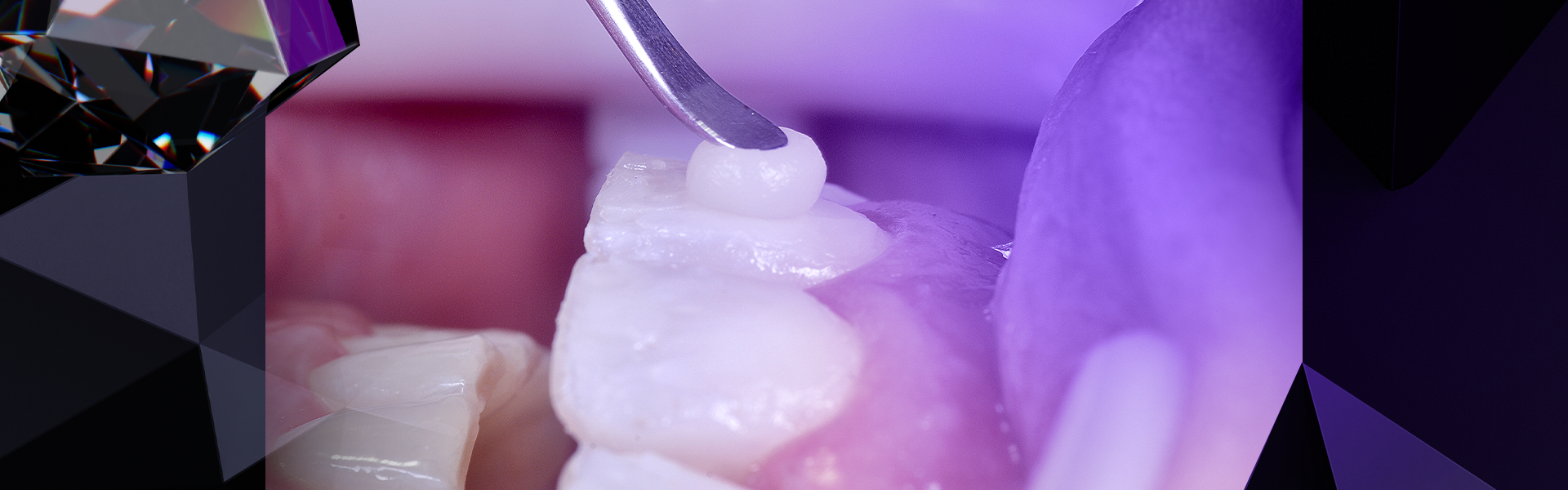 post resinas 1 1 - Como escolher a melhor resina para seu procedimento dental?