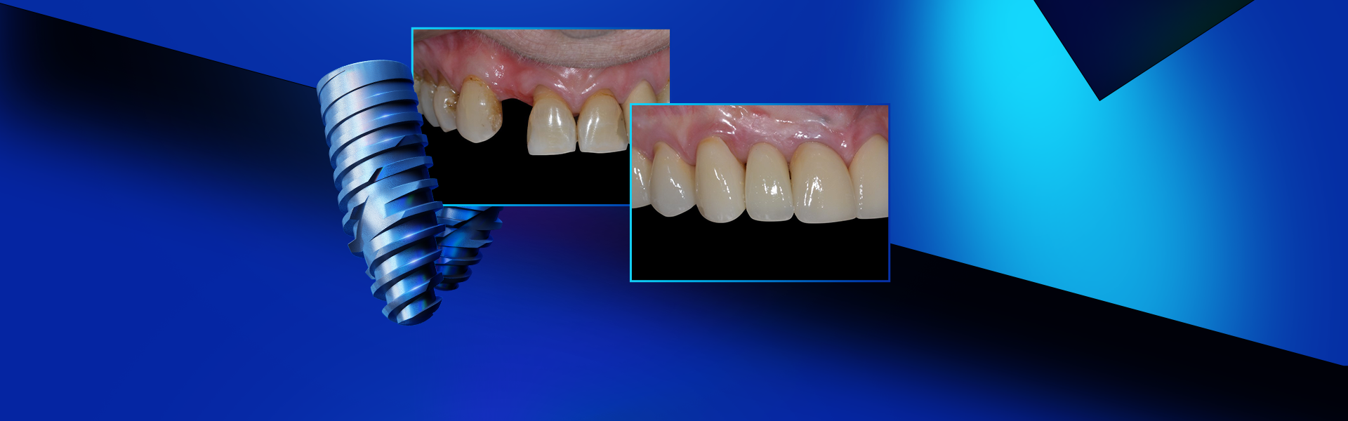77475 Reabilitacao Dento Alveolar Com Implante Arcsys - Rehabilitación dentoalveolar con implante Arcsys, injerto conjuntivo y sustituto óseo Nanosynt