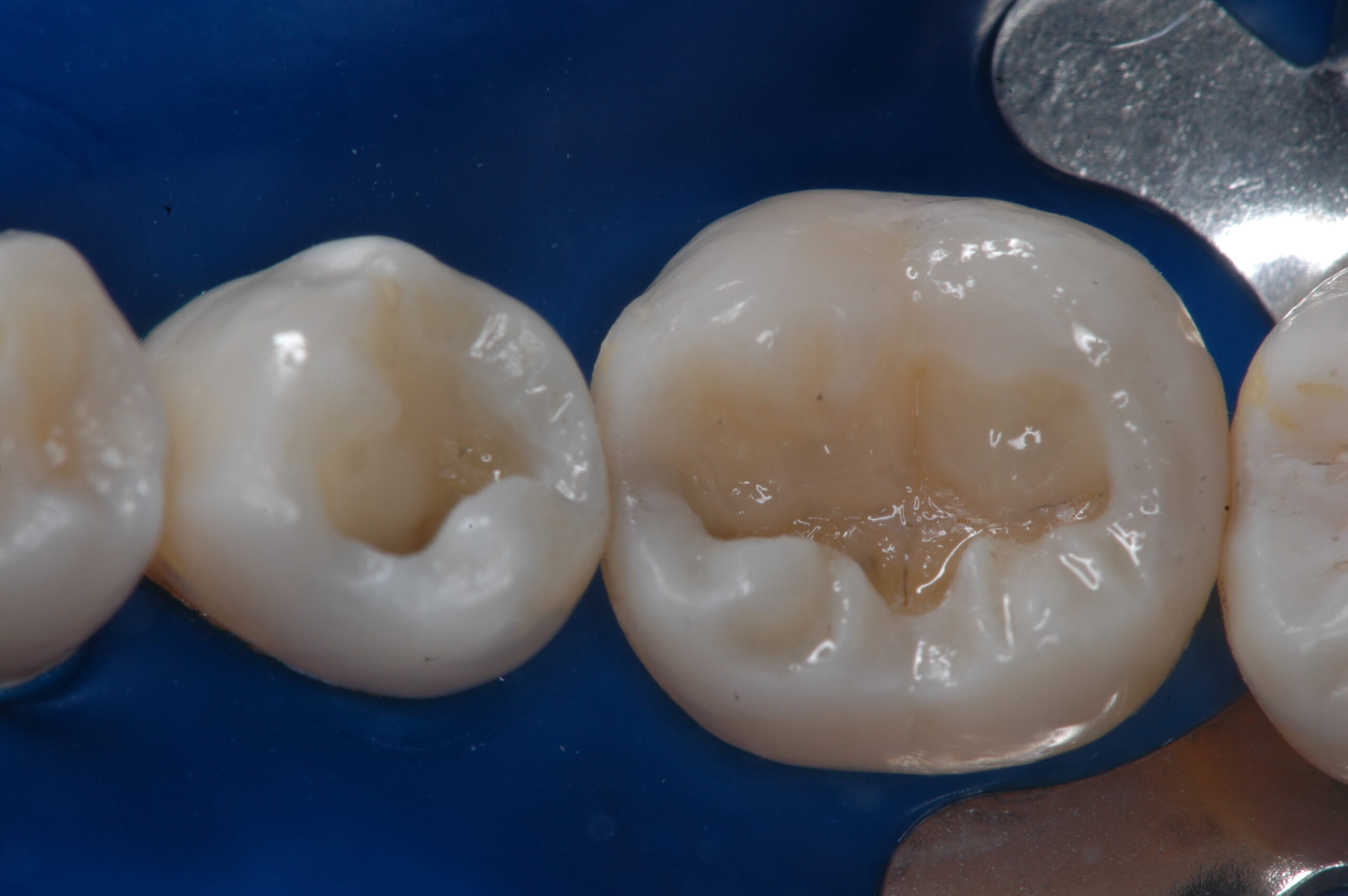Figura 11: Inserção da resina Llis EA3 (FGM) nas cúspides vestibulares para confecção da dentina.