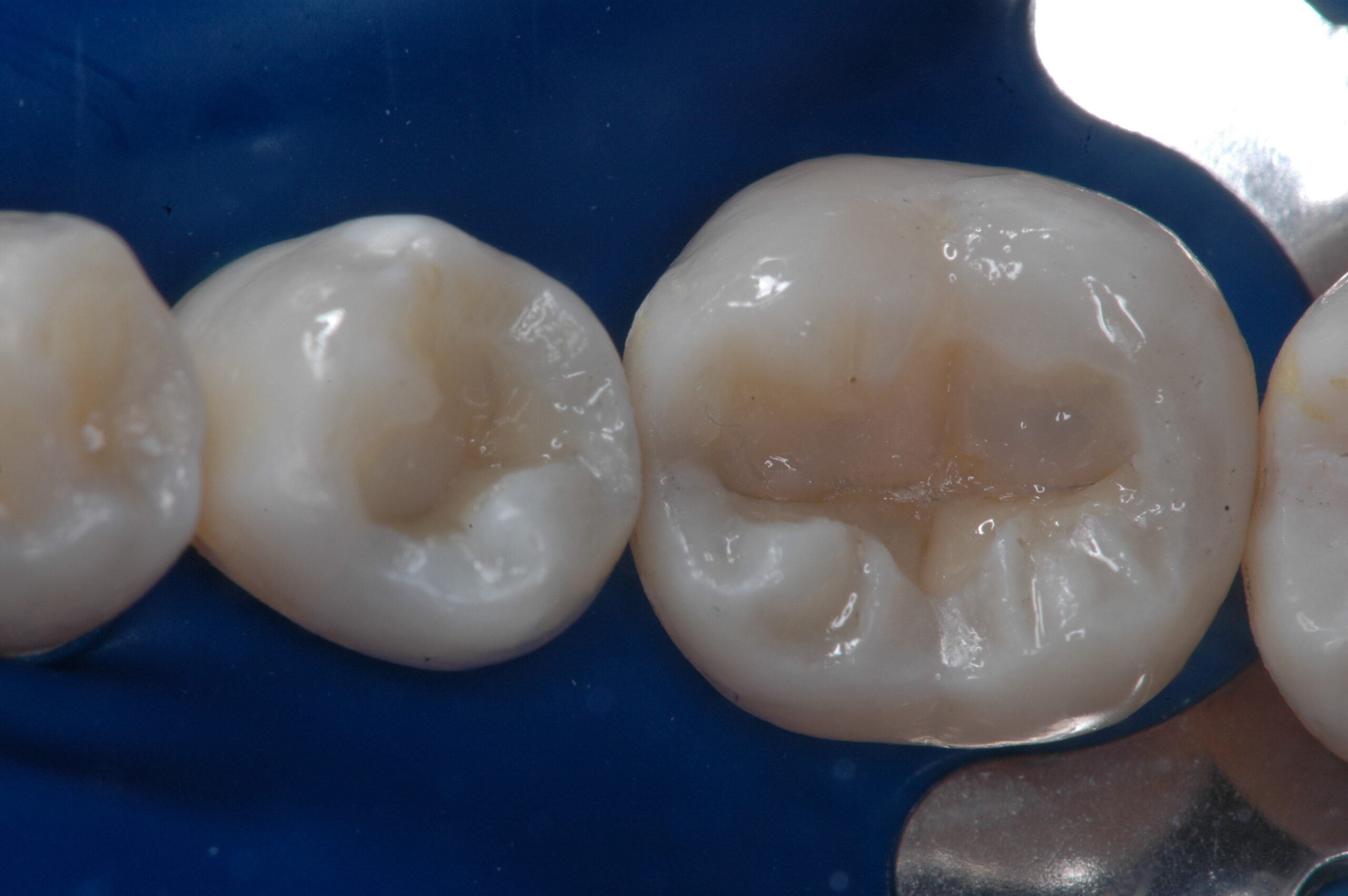 Figura 12: Inserção da resina Llis EA3 (FGM) nas cúspides palatinas para confecção da dentina.