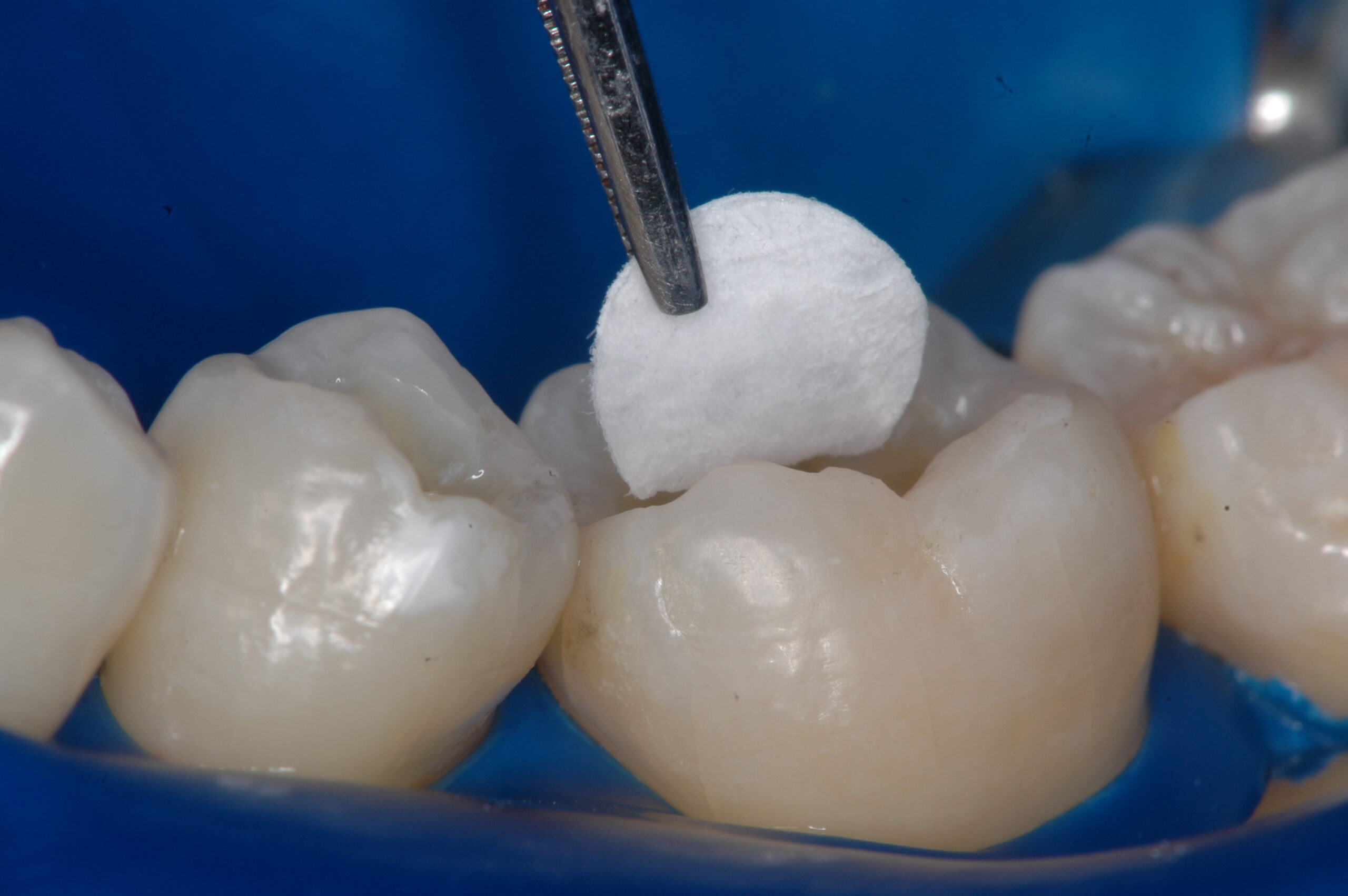 Figura 7: Secagem da cavidade com papel feltro mantendo a dentina levemente úmida.