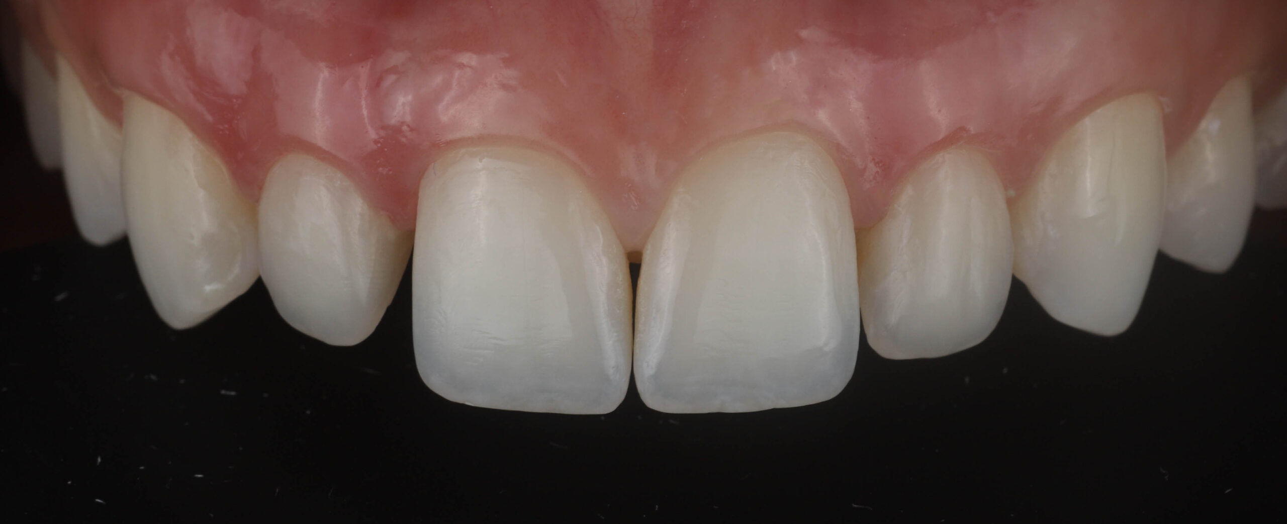 Fig. 2 - Aparência dentária após a remoção das restaurações antigas.