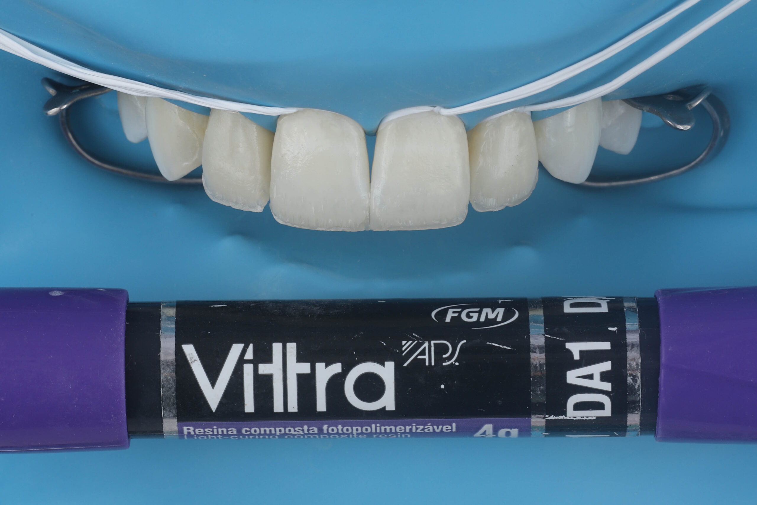Fig. 5 - Confecção da dentina e dos mamelos com resina Vittra DA1.