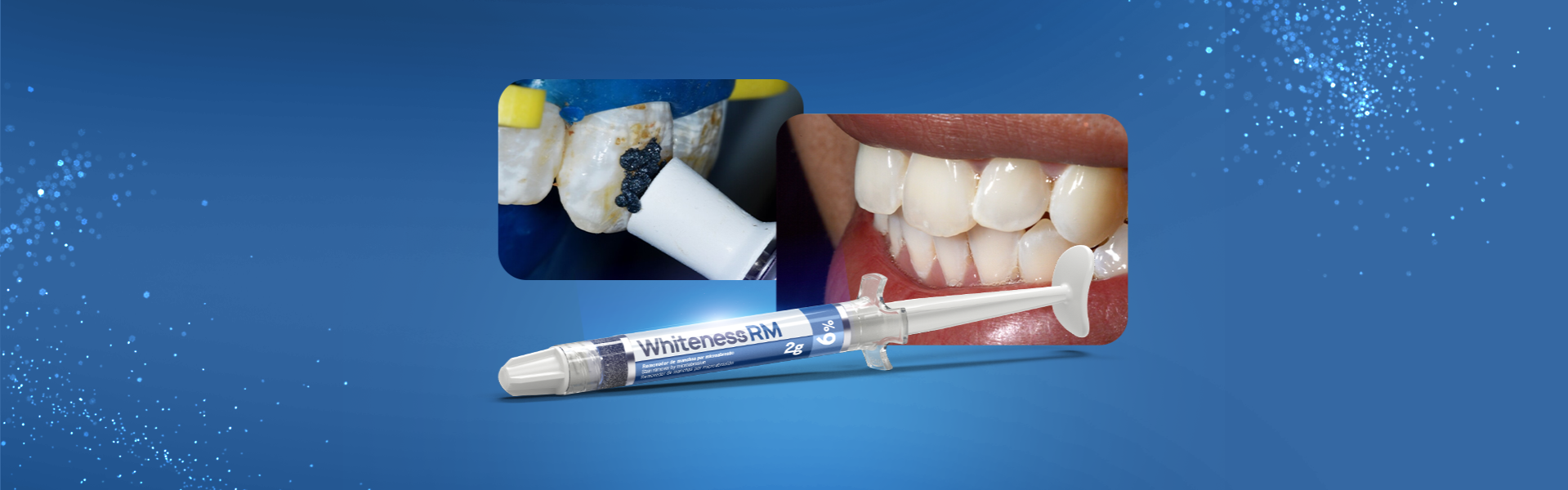 Whiteness RM - Soluções minimamente invasivas para a fluorose dental: microabrasão e clareamento