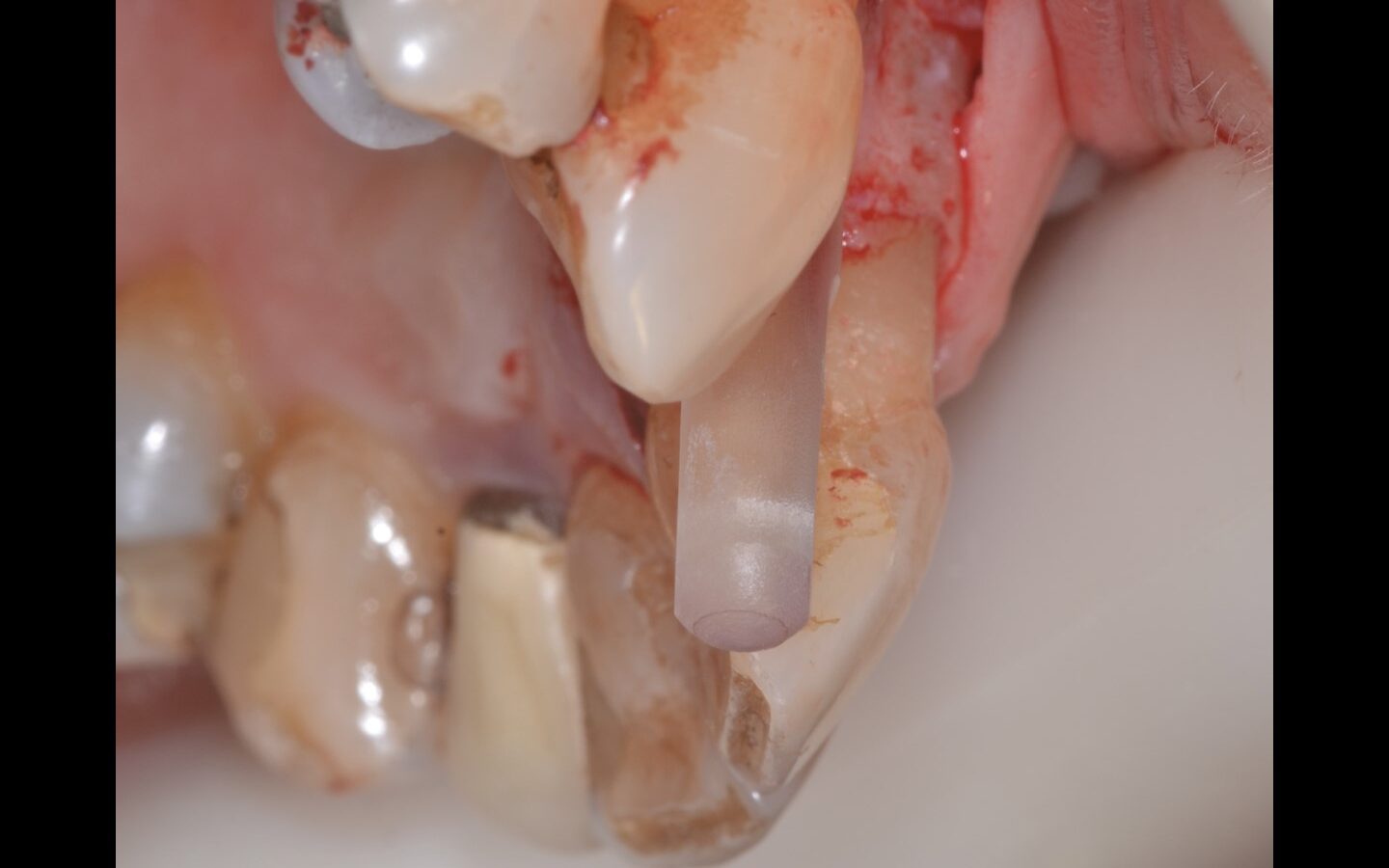 image10 e1678726269663 - Reabilitação dento-alveolar com implante Arcsys, enxerto conjuntivo e substituto ósseo Nanosynt