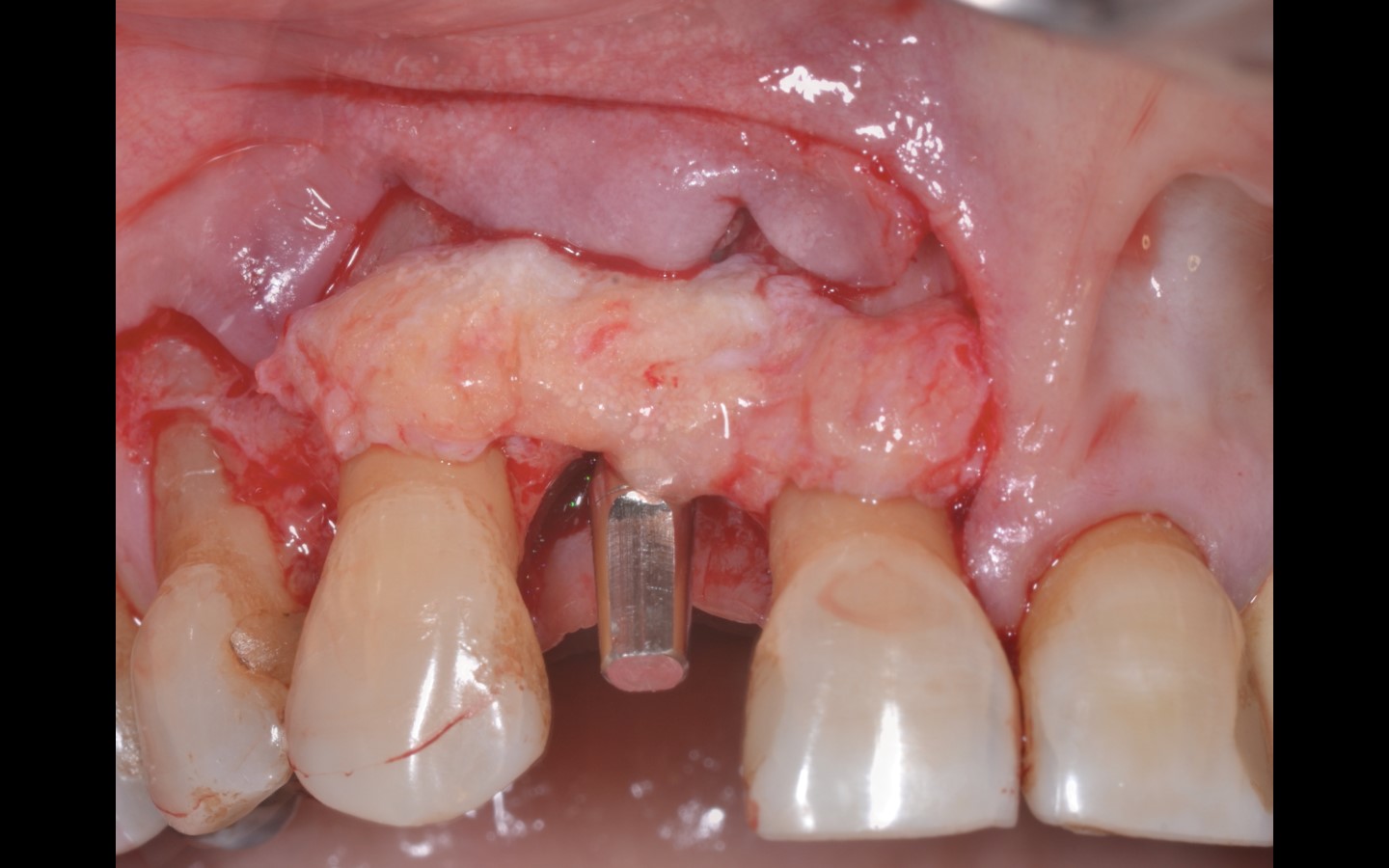 image11 - Reabilitação dento-alveolar com implante Arcsys, enxerto conjuntivo e substituto ósseo Nanosynt