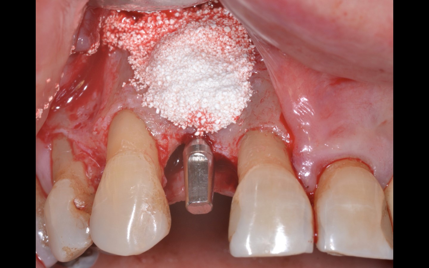 image12 - Reabilitação dento-alveolar com implante Arcsys, enxerto conjuntivo e substituto ósseo Nanosynt